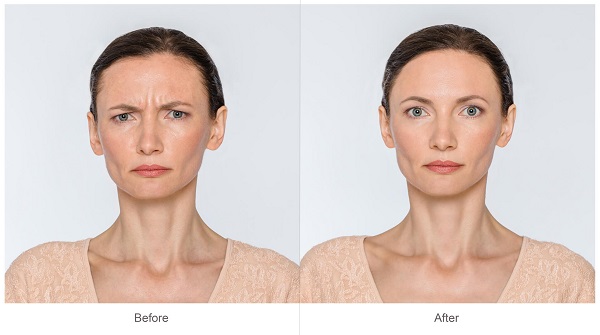 Fjerne sinnarynke med botox